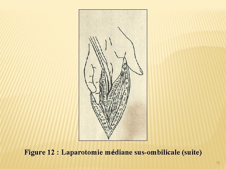 Figure 12 : Laparotomie médiane sus-ombilicale (suite) 18 