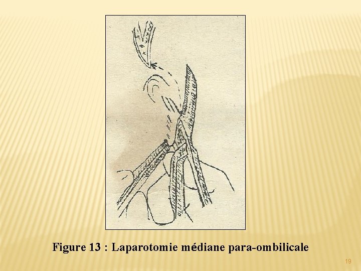 Figure 13 : Laparotomie médiane para-ombilicale 19 