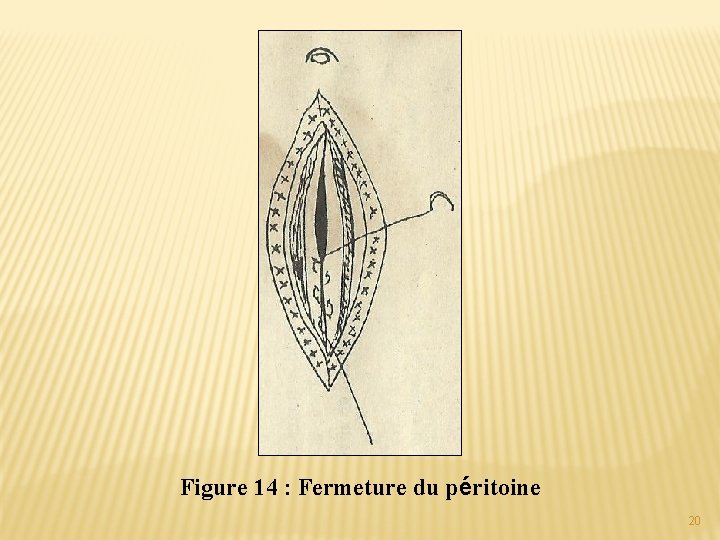 Figure 14 : Fermeture du péritoine 20 