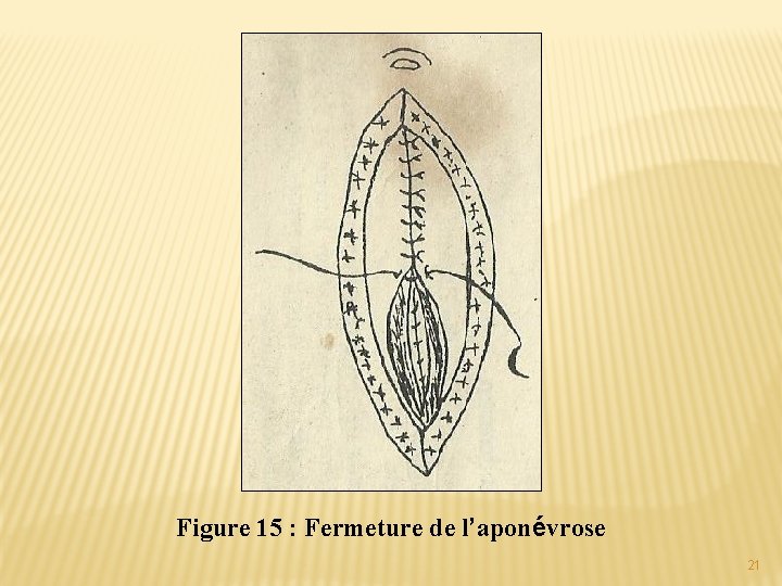 Figure 15 : Fermeture de l’aponévrose 21 