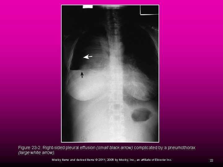 Figure 23 -2. Right-sided pleural effusion (small black arrow) complicated by a pneumothorax (large