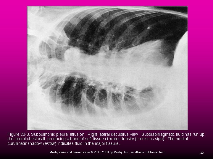 Figure 23 -3. Subpulmonic pleural effusion. Right lateral decubitus view. Subdiaphragmatic fluid has run