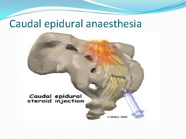 Caudal epidural anaesthesia 