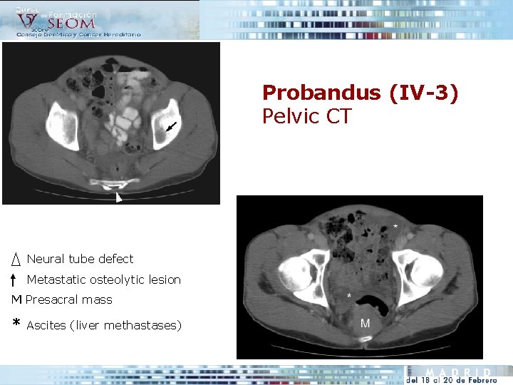 Probandus (IV-3) Pelvic CT Neural tube defect Metastatic osteolytic lesion M Presacral mass *