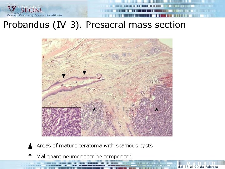 Probandus (IV-3). Presacral mass section Areas of mature teratoma with scamous cysts * Malignant