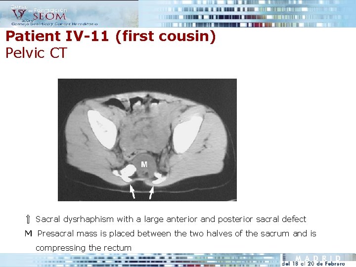 Patient IV-11 (first cousin) Pelvic CT Sacral dysrhaphism with a large anterior and posterior