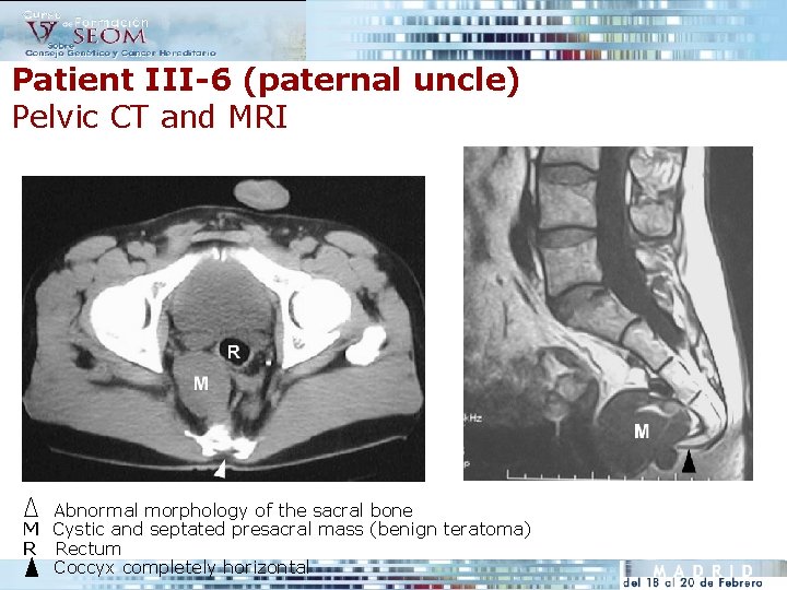 Patient III-6 (paternal uncle) Pelvic CT and MRI Abnormal morphology of the sacral bone