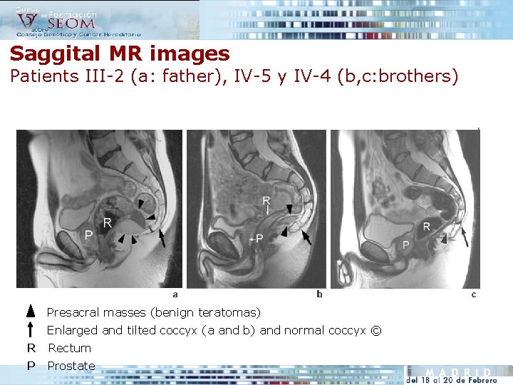 Saggital MR images Patients III-2 (a: father), IV-5 y IV-4 (b, c: brothers) Presacral