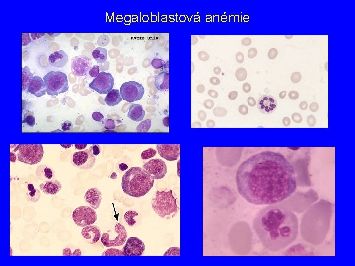 Megaloblastová anémie 