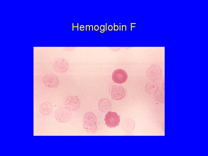Hemoglobin F 