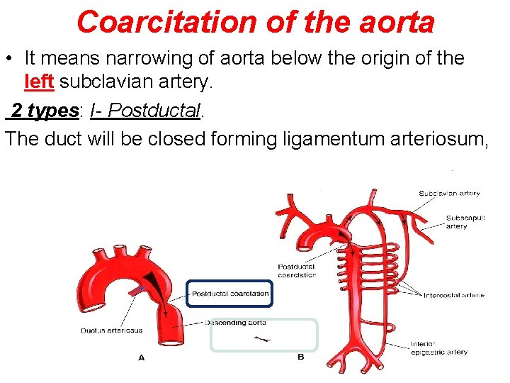 Coarcitation of the aorta • It means narrowing of aorta below the origin of