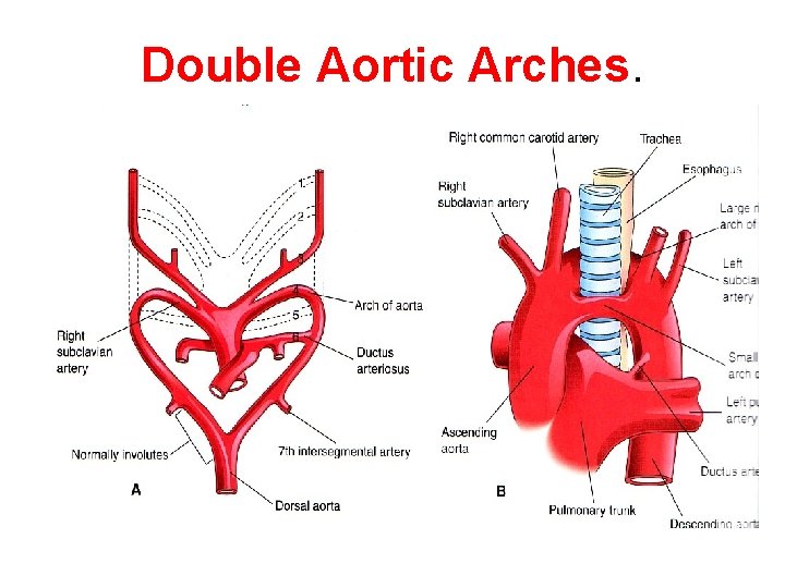 Double Aortic Arches. 