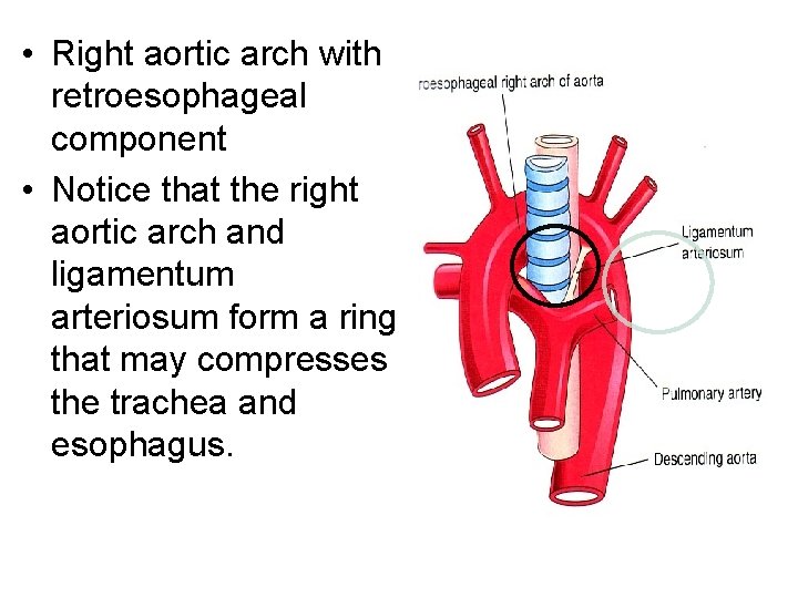  • Right aortic arch with retroesophageal component • Notice that the right aortic