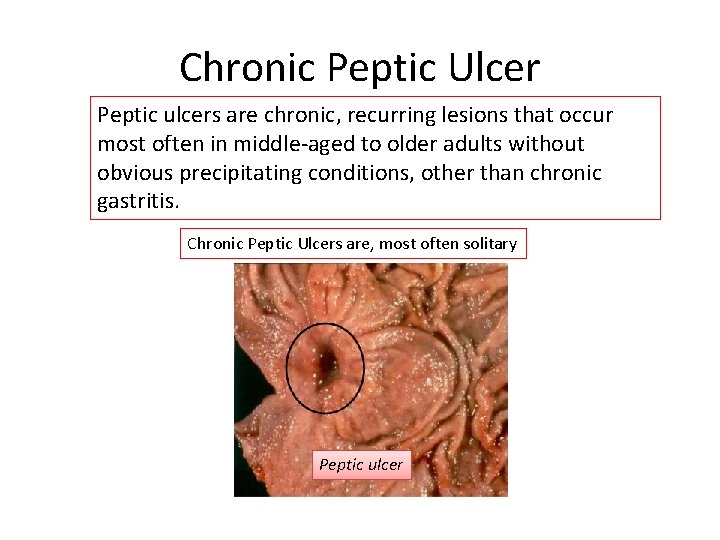 Chronic Peptic Ulcer Peptic ulcers are chronic, recurring lesions that occur most often in