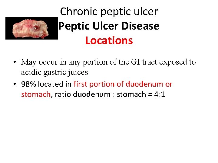 Chronic peptic ulcer Peptic Ulcer Disease Locations • May occur in any portion of