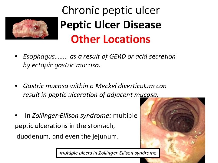 Chronic peptic ulcer Peptic Ulcer Disease Other Locations • Esophagus……. as a result of