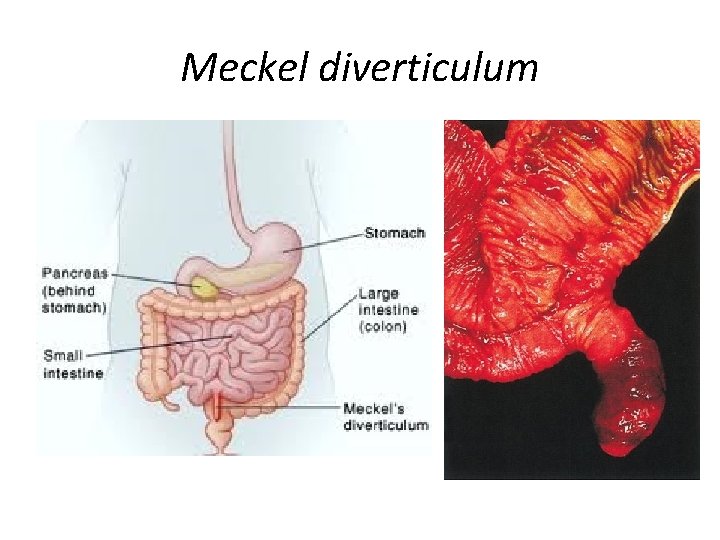 Meckel diverticulum 