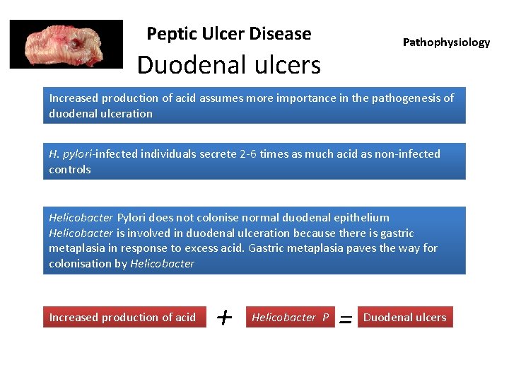 Peptic Ulcer Disease Pathophysiology Duodenal ulcers Increased production of acid assumes more importance in