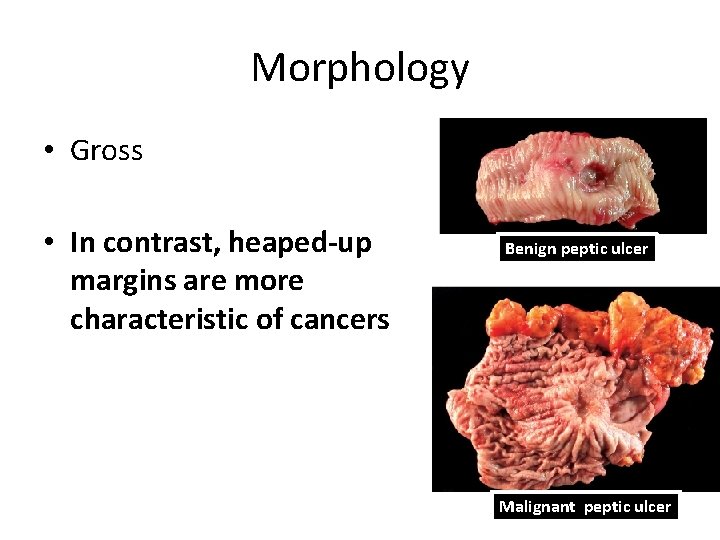 Morphology • Gross • In contrast, heaped-up margins are more characteristic of cancers Benign