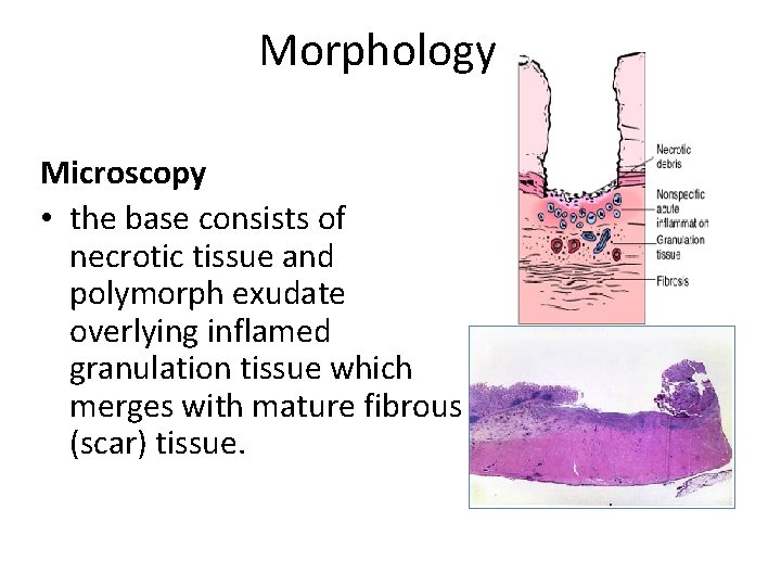 Morphology Microscopy • the base consists of necrotic tissue and polymorph exudate overlying inflamed