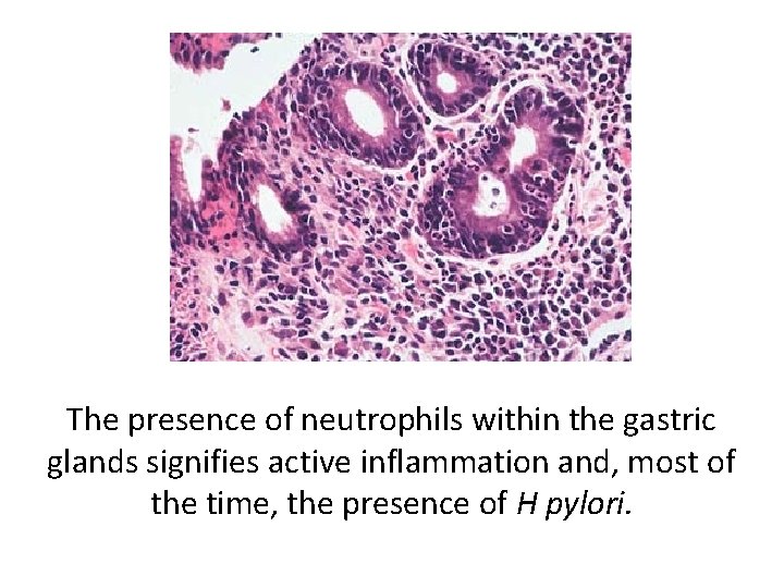 The presence of neutrophils within the gastric glands signifies active inflammation and, most of