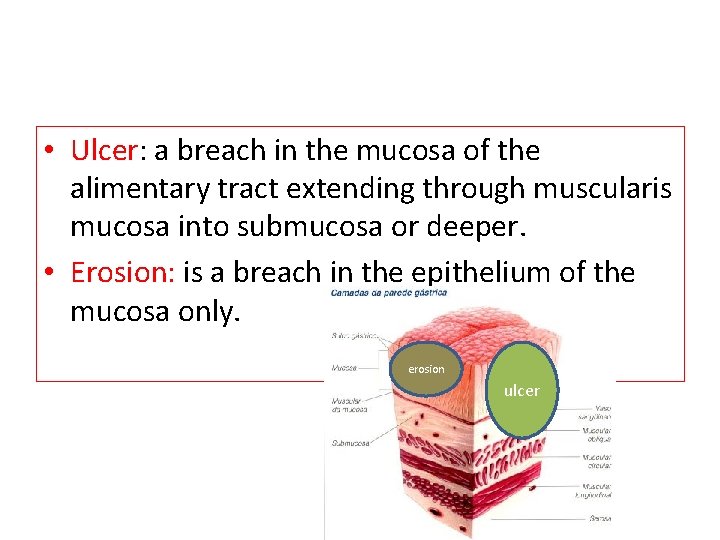  • Ulcer: a breach in the mucosa of the alimentary tract extending through