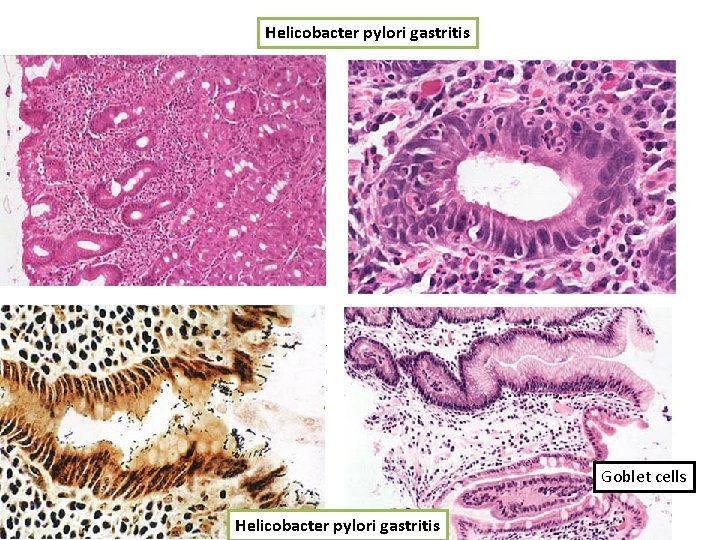 Helicobacter pylori gastritis Goblet cells Helicobacter pylori gastritis 
