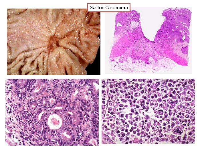 Gastric Carcinoma 