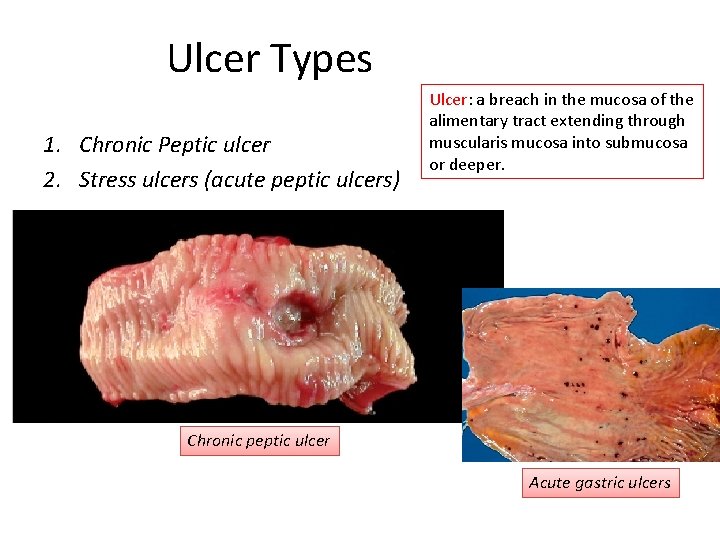 Ulcer Types 1. Chronic Peptic ulcer 2. Stress ulcers (acute peptic ulcers) Ulcer: a