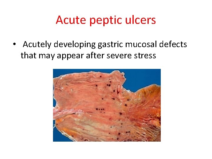 Acute peptic ulcers • Acutely developing gastric mucosal defects that may appear after severe