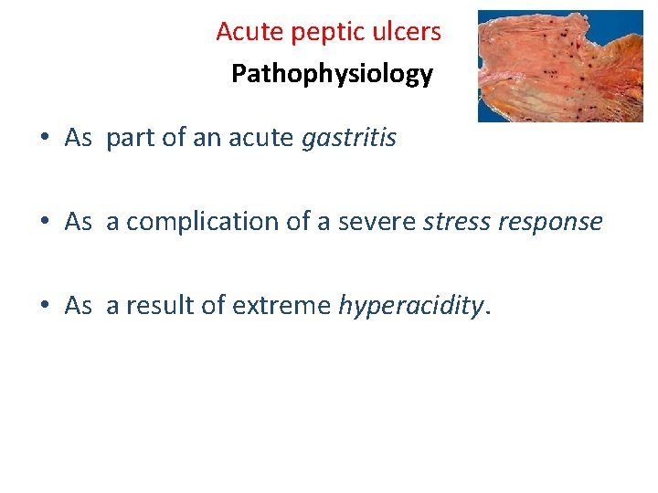Acute peptic ulcers Pathophysiology • As part of an acute gastritis • As a