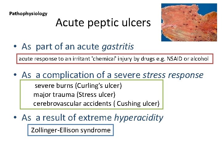 Pathophysiology Acute peptic ulcers • As part of an acute gastritis acute response to