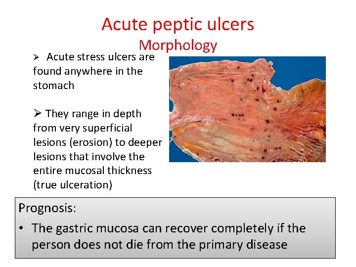 Acute peptic ulcers Morphology Ø Acute stress ulcers are found anywhere in the stomach
