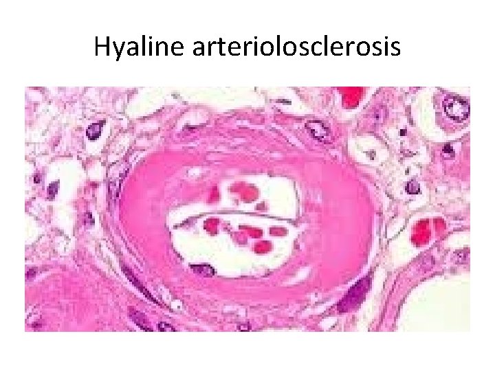 Hyaline arteriolosclerosis 