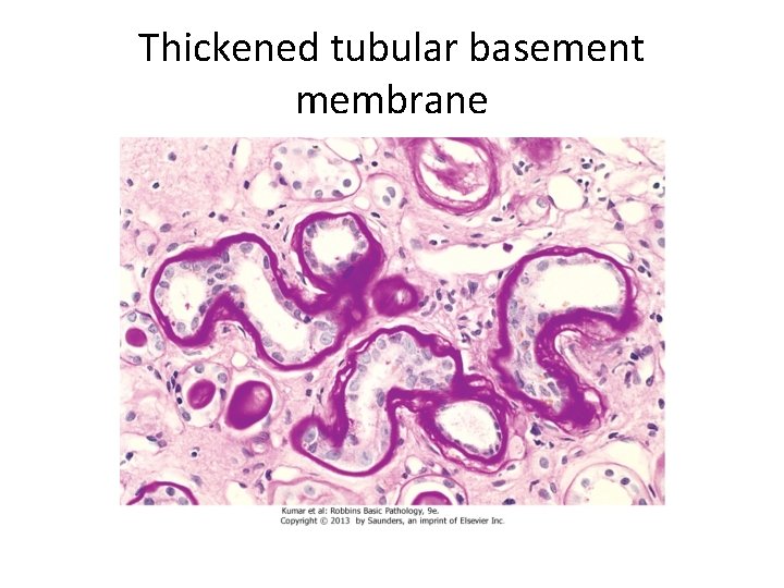 Thickened tubular basement membrane 