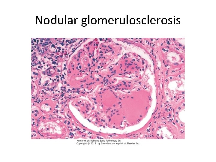 Nodular glomerulosclerosis 