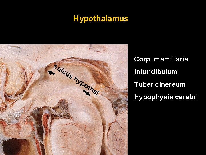 Hypothalamus su Corp. mamillaria lcu Infundibulum sh yp oth al. Tuber cinereum Hypophysis cerebri