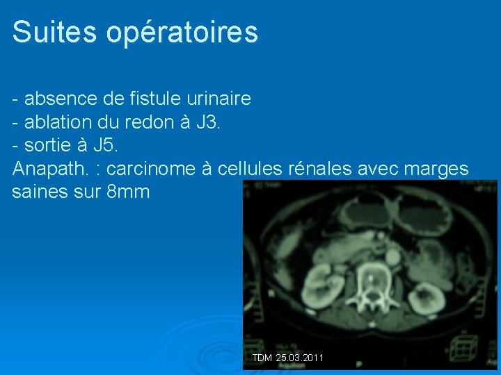 Suites opératoires - absence de fistule urinaire - ablation du redon à J 3.