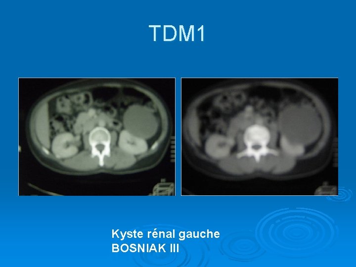 TDM 1 Kyste rénal gauche BOSNIAK III 