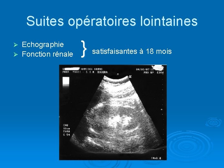 Suites opératoires lointaines Echographie Ø Fonction rénale Ø } satisfaisantes à 18 mois 