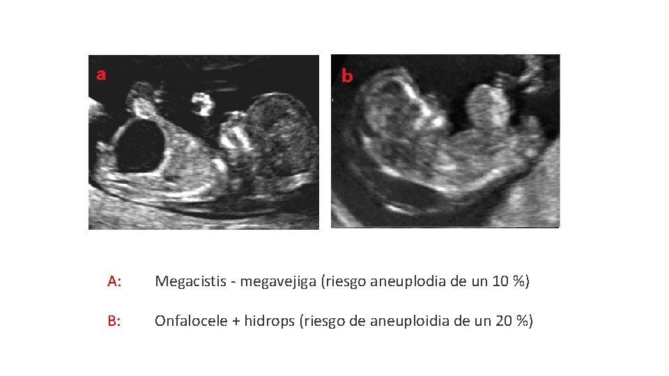 A: Megacistis - megavejiga (riesgo aneuplodia de un 10 %) B: Onfalocele + hidrops