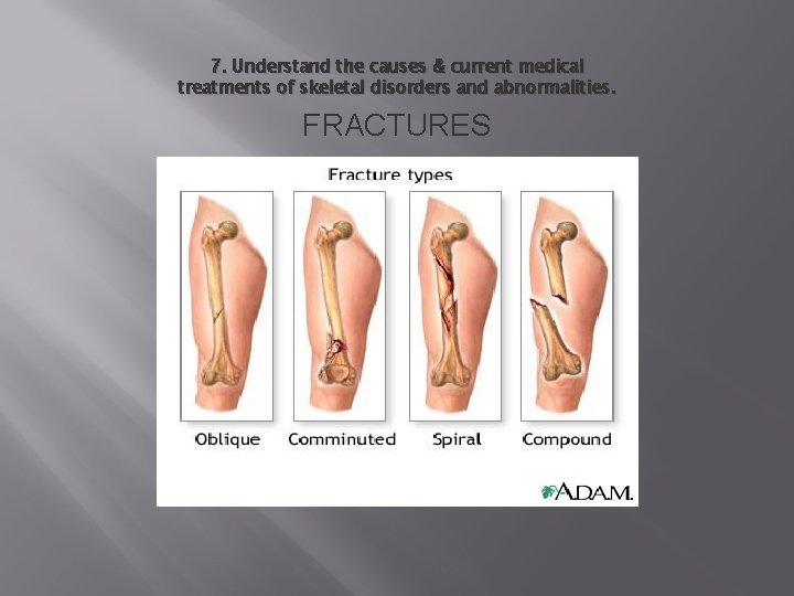 7. Understand the causes & current medical treatments of skeletal disorders and abnormalities. FRACTURES