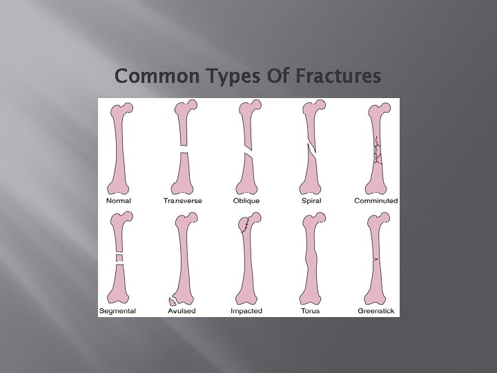 Common Types Of Fractures 