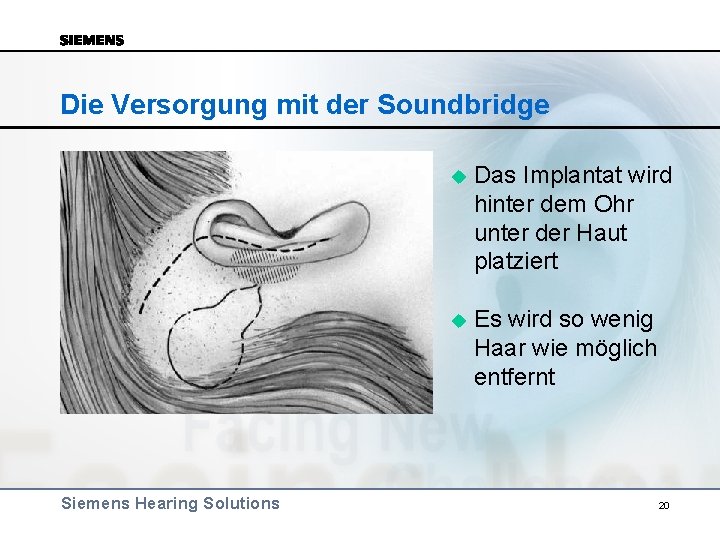 Die Versorgung mit der Soundbridge Siemens Hearing Solutions u Das Implantat wird hinter dem