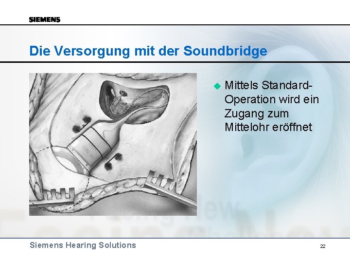 Die Versorgung mit der Soundbridge u Siemens Hearing Solutions Mittels Standard. Operation wird ein