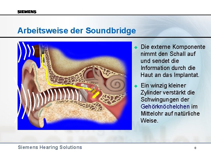 Arbeitsweise der Soundbridge Siemens Hearing Solutions u Die externe Komponente nimmt den Schall auf