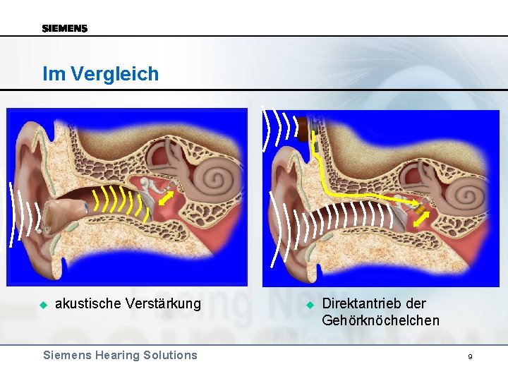 Im Vergleich u akustische Verstärkung Siemens Hearing Solutions u Direktantrieb der Gehörknöchelchen 9 