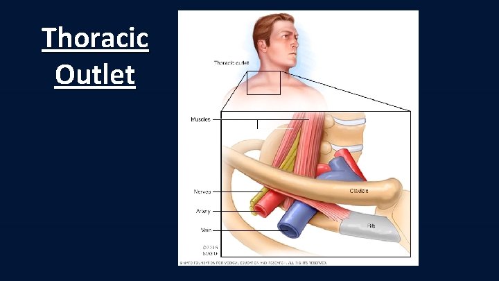 Thoracic Outlet 