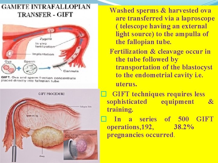 Washed sperms & harvested ova are transferred via a laproscope ( telescope having an