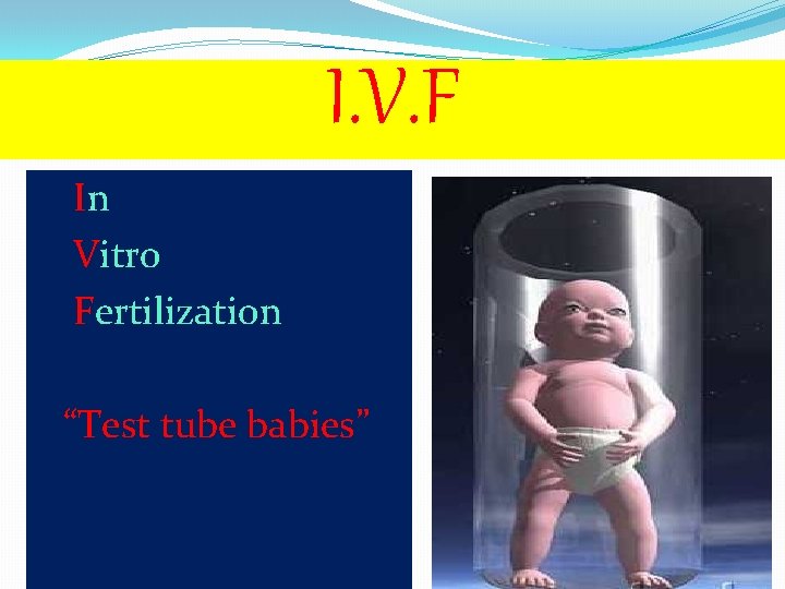 I. V. F In Vitro Fertilization “Test tube babies” 